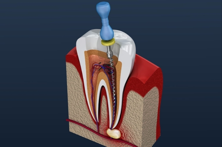 Root Canal Treatment